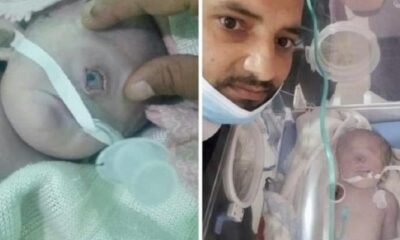 حالة نادرة.. ولادة طفل يمني بعين واحدة – السودان الحرة