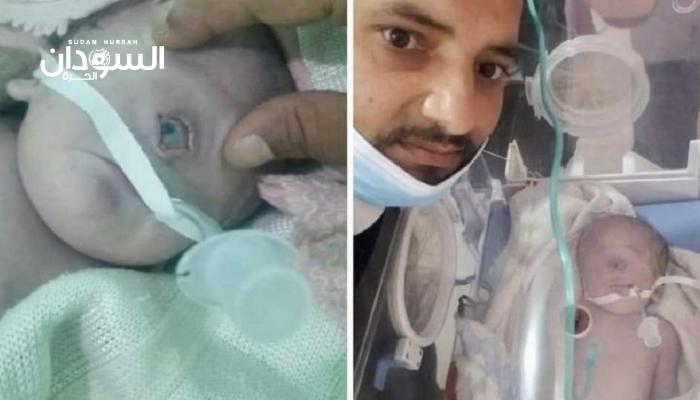 حالة نادرة.. ولادة طفل يمني بعين واحدة – السودان الحرة