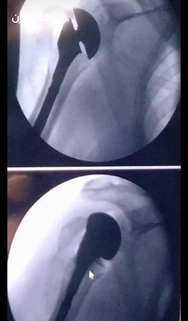 لأوّل مرة في السودان.. إجراء عملية استبدال مفصل الكتف