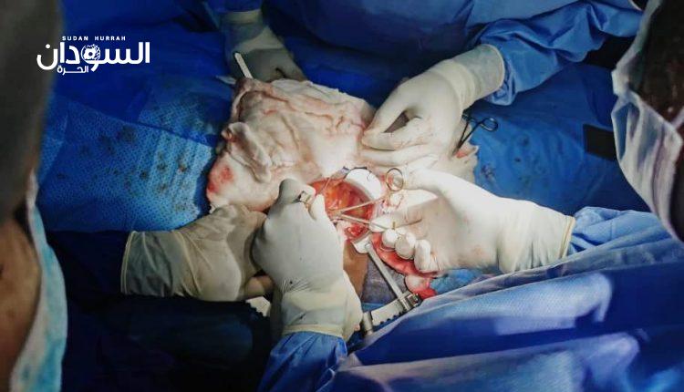 استئناف عمليات زراعة الكلي بمستشفى الجزيرة بمدني – السودان الحرة